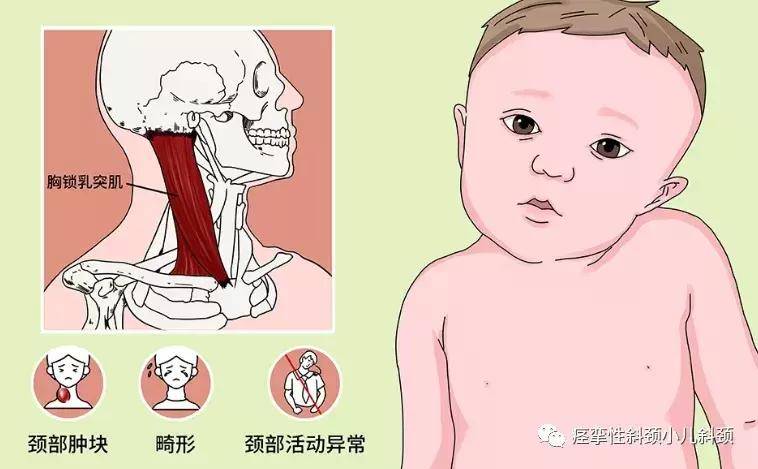 关于八个月宝宝斜颈的应对之策