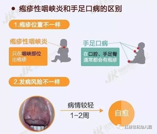 两个月婴儿疱疹性咽峡炎，理解、预防与治疗