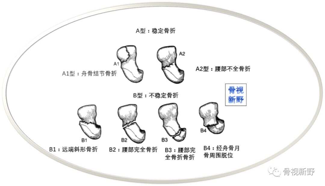 舟骨骨折一个月能否康复，解析、治疗与恢复之路